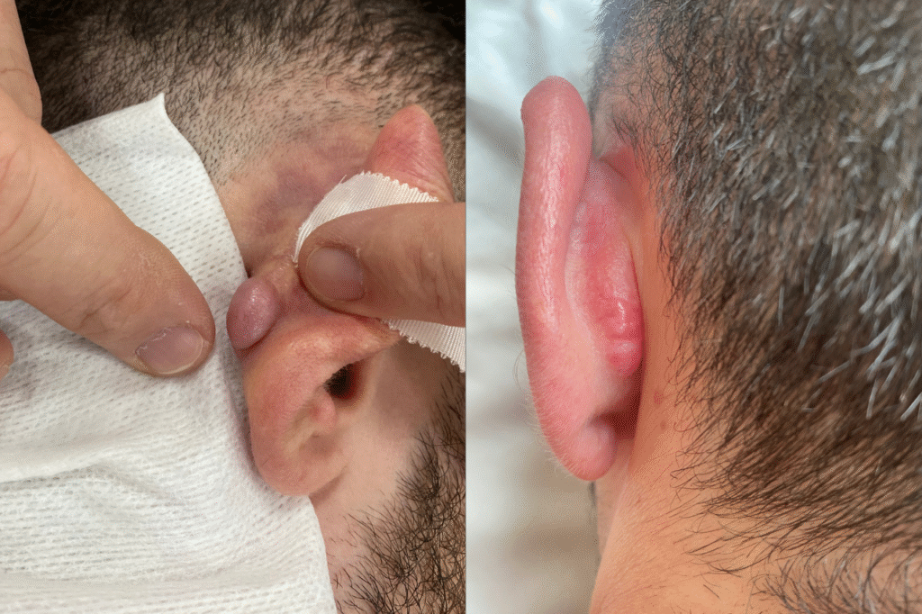 Microcirugias, nodulos, quistes, verrugas, reconstruccion, medico estetico mataro
